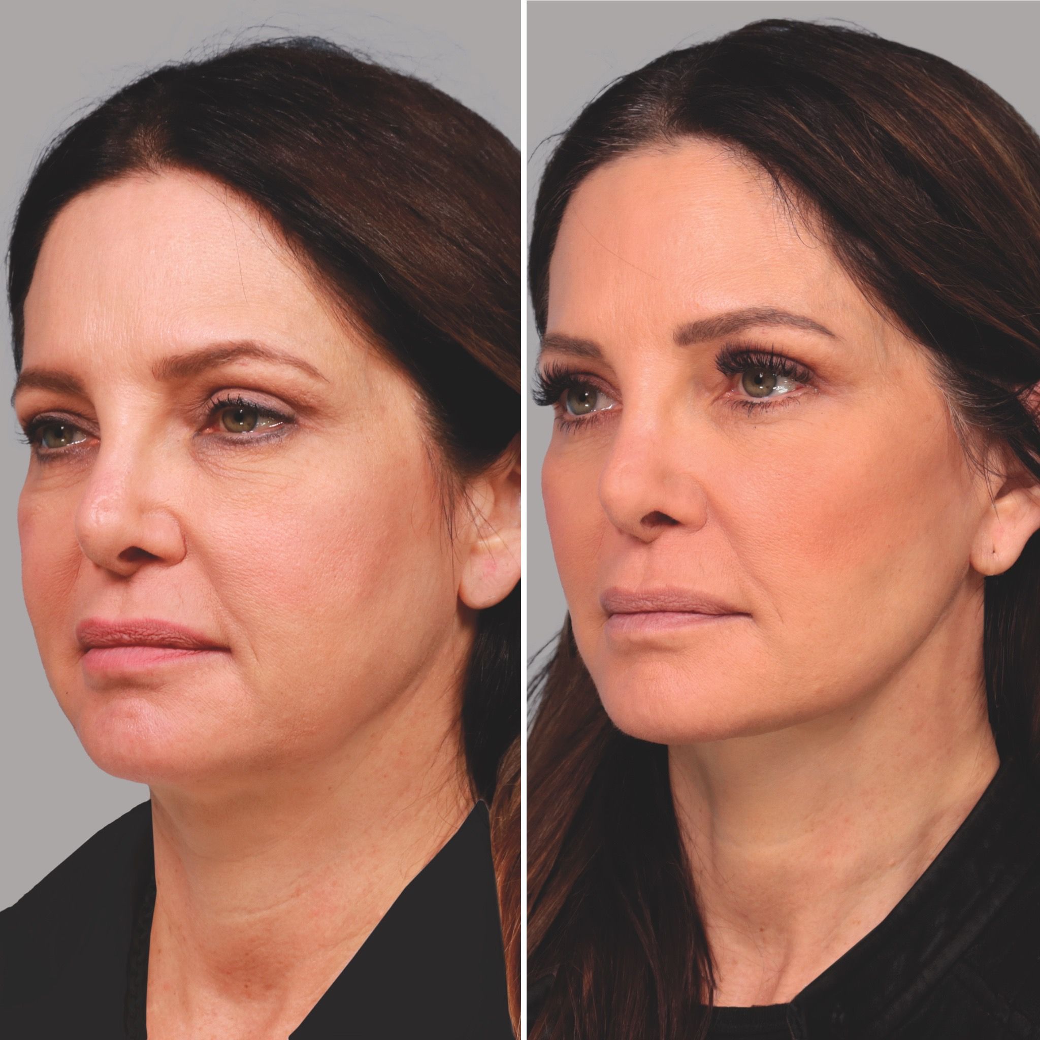 Palo Alto, CA facial plastic surgeons David Lieberman, MD and Sachin Parikh, MD