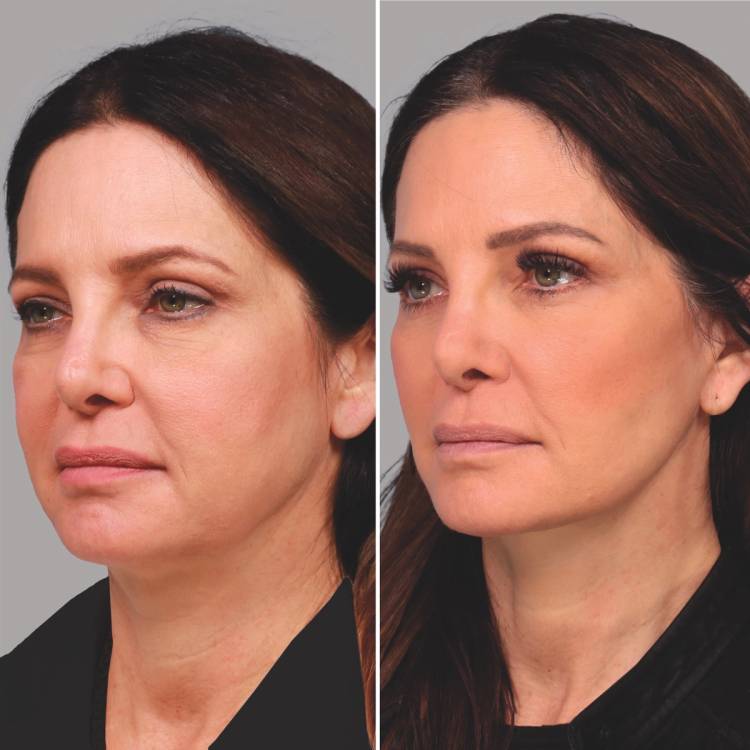 Palo Alto, CA facial plastic surgeons David Lieberman, MD and Sachin Parikh, MD