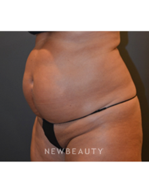 Dr. Aviva Preminger - CoolSculpting - Before