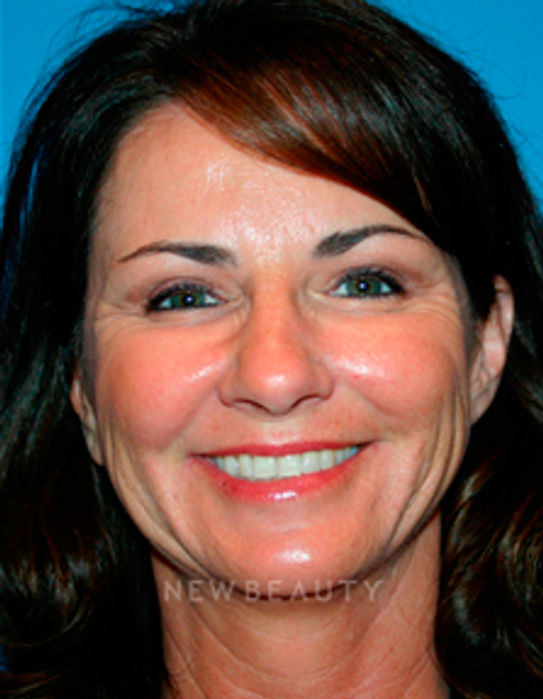 Dr. Kelly Bomer Liquid Facelift - After