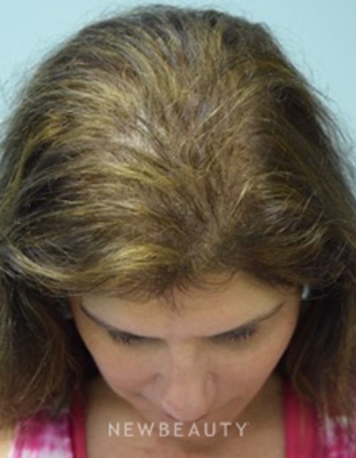 Dr. Jeffrey B. Wise - Hair Transplant - After