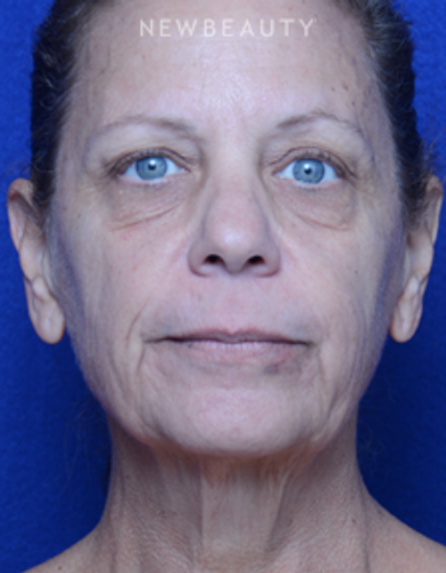 Dr. Alan Durkin - Facelift with Fat Transfer - Before