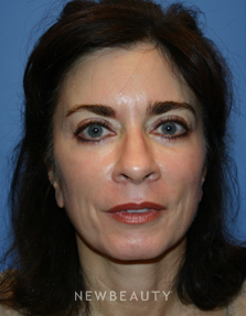 Dr. Kelly Bomer - Facial Rejuvenation - Before