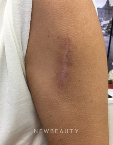 Dr. Julie Russak - Laser Resurfacing - Before