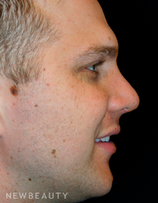 Dr. Kelly Bomer Rhinoplasty - After