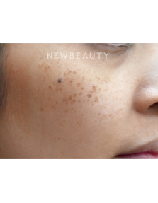 Dr. Jody Levine - Laser Skin Resurfacing - Before