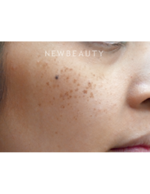 Dr. Jody Levine - Laser Skin Resurfacing - Before