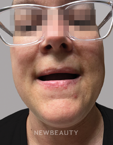 Dr. Anna Chacon – Skin Treatment - 34277072 - Before