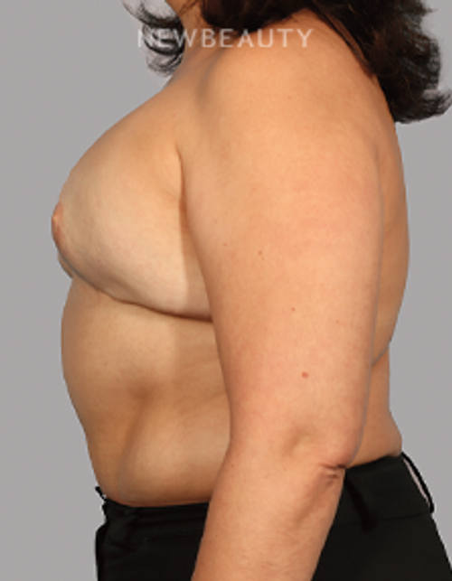 Dr. Kurtovic - Breast Lift - 20637640 - Before