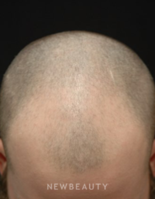 Dr. Jeffrey B. Wise - Hair Transplant - Before
