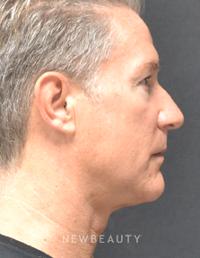 Dr. Julie Russak - CoolMini - After