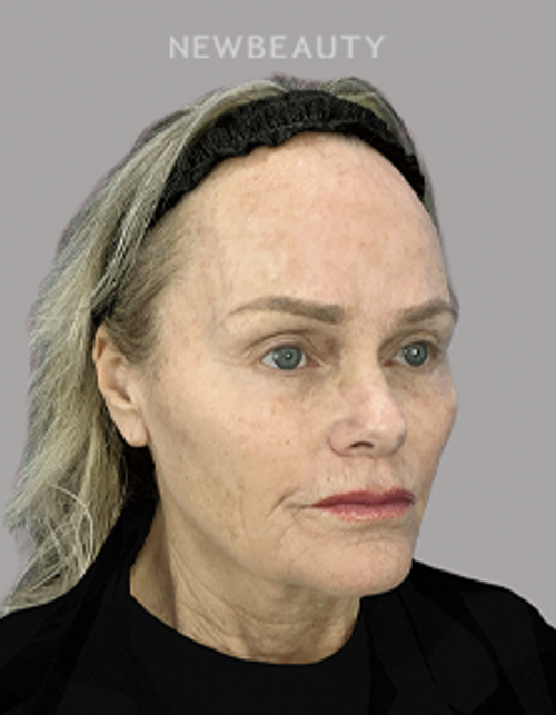 Dr. Sheila Barbarino-Laser-5479883 - After