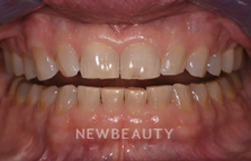 Dr. Sara Cummins - Smile Makeover - 14738055 - Before