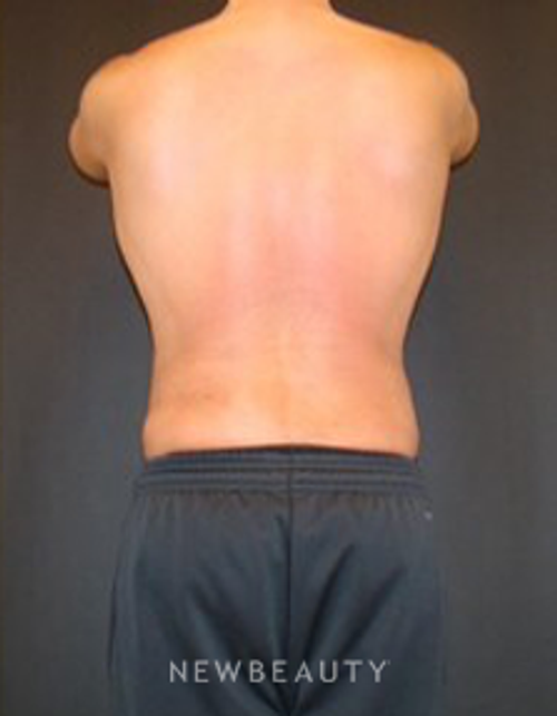 Dr. Joel Schlessinger - SmartLipo - After