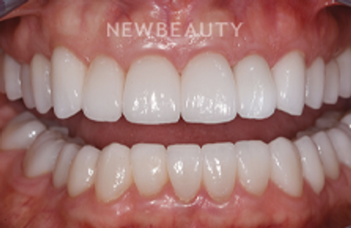 Dr. Sara Cummins - Smile Makeover - 14738160 - After