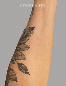 Dr. Anna Chacon - Psoriasis - 34279380 - After