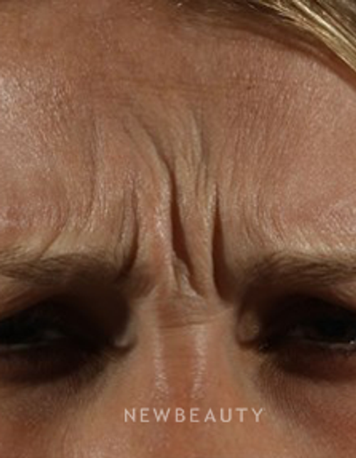 Dr. Marina Peredo - Botox - Before