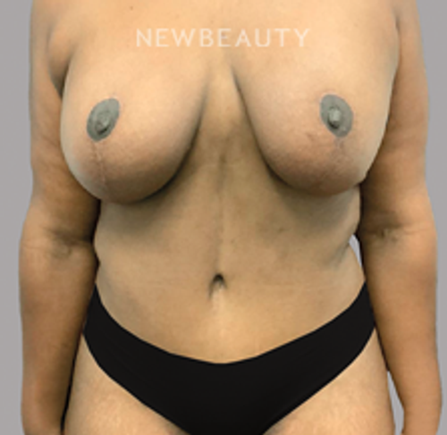 Dr. Ralph Garramone - Mommy Makeover - 44409267 - After