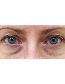 Dr. Julie Russak Injectables & Fillers - Before