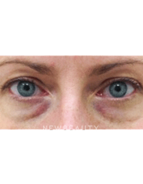 Dr. Julie Russak Injectables & Fillers - Before