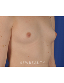 Dr. Peter Geldner - Breast Implants - Before