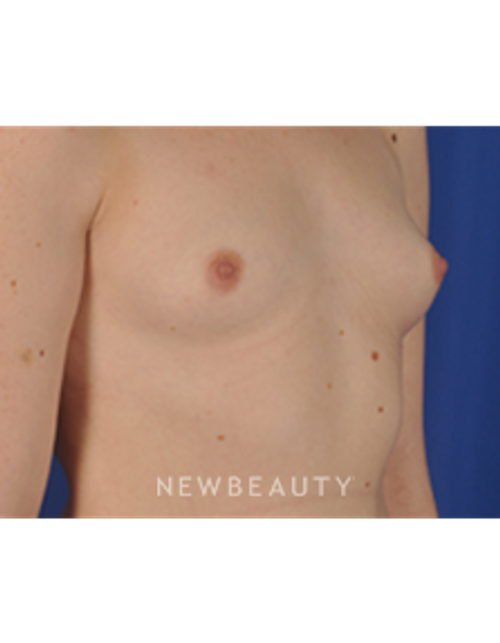 Dr. Peter Geldner - Breast Implants - Before