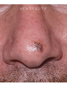 Dr. Sean Simon - Lasers - Before