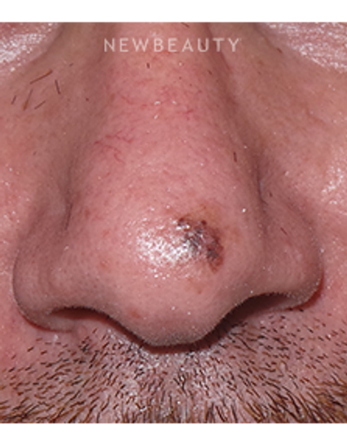 Dr. Sean Simon - Lasers - Before