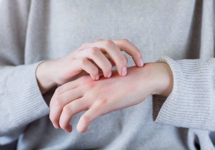 Why Dermatologists Are Watching This Eczema Treatment Closely