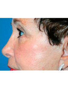 Dr. Kelly Bomer Liquid Facelift - Before