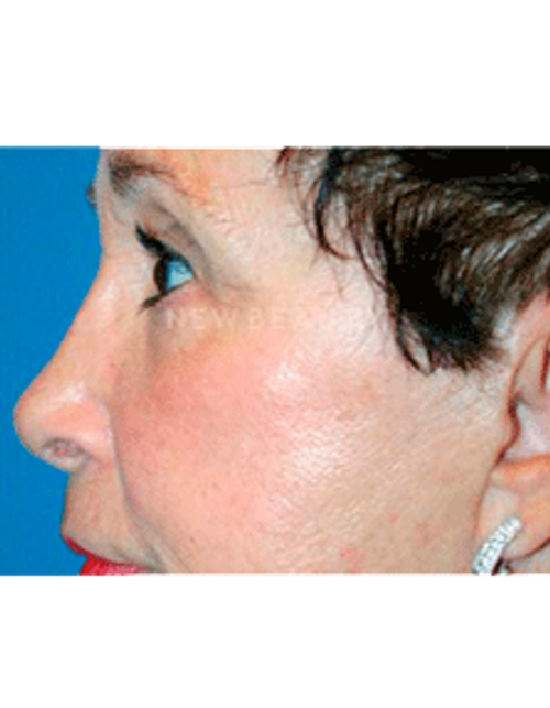Dr. Kelly Bomer Liquid Facelift - Before