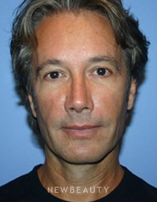 Dr. Kelly Bomer - Perlane - After