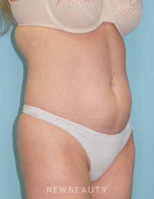 Dr. Sean Simon - SmartLipo - Before