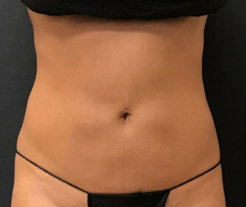 Dr. Janet Allenby - CoolSculpting - After