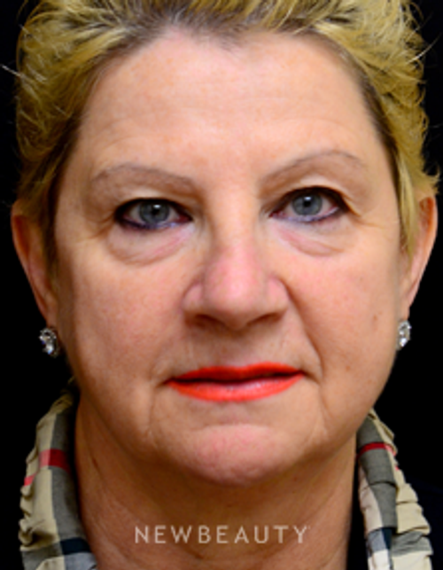 Dr. Mokhtar Asaadi - Browlift, Eyelift, Injectables - Before
