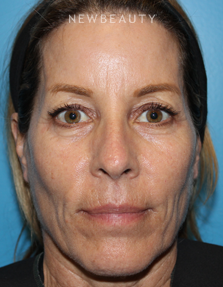 Dr. Ava Shamban - Full Facial Rejuvenation - Before