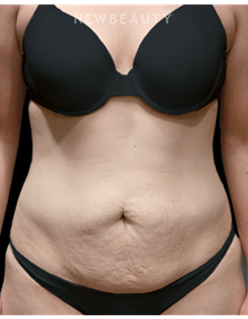 Dr. Bryan W. Gawley - A New Waistline - Before