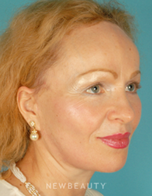 Dr. David Kim Facelift, Necklift - After