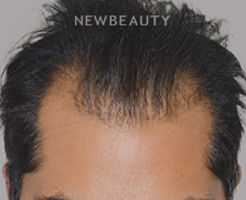 Dr. Anthony Bared - Hair Transplant - 46164563 - Before