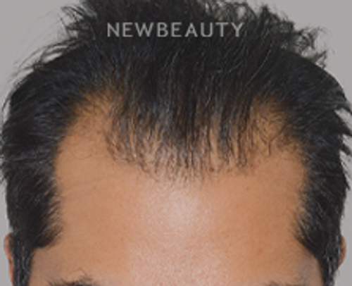 Dr. Anthony Bared - Hair Transplant - 46164563 - Before