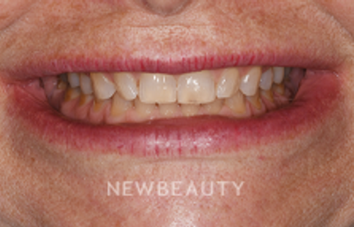 Dr. Sara Cummins - Smile Makeover - 14738055 - Before