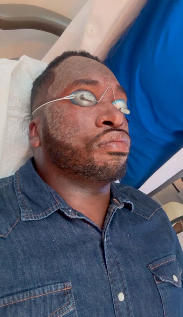 During UltraClear laser facial