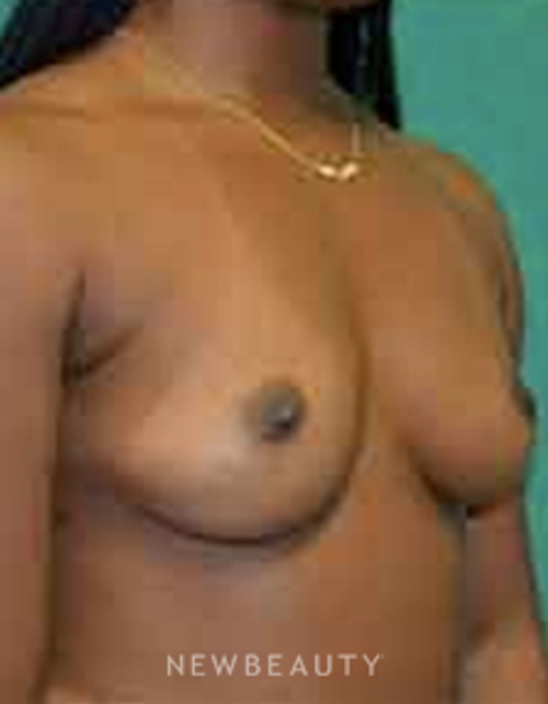 Dr. Aviva Preminger - Breast Augmentation - Before