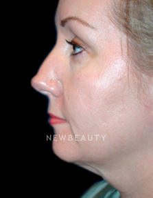 Dr. Kelly Bomer Facelift, Necklift - Before