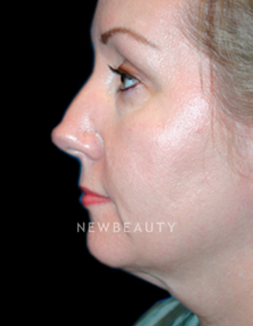 Dr. Kelly Bomer Facelift, Necklift - Before
