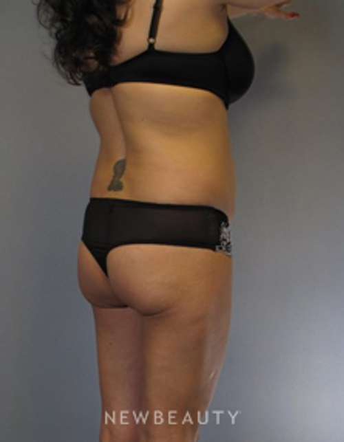 Dr. German Newall - Butt Augmentation - Before