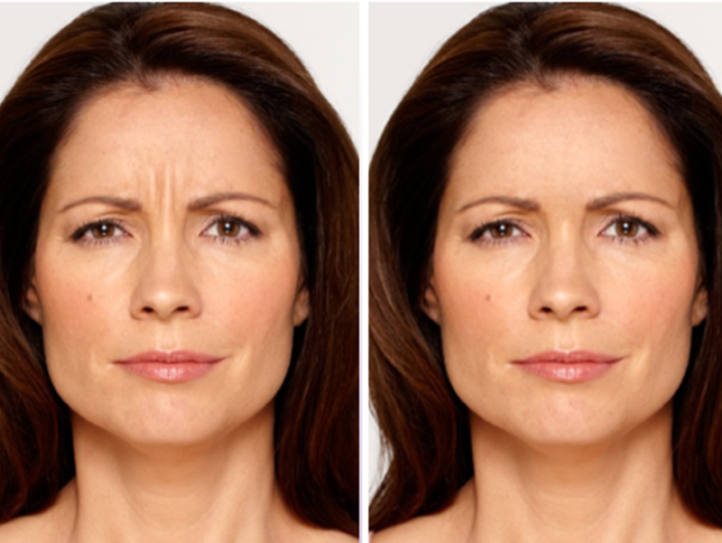 botox Main Newbeauty