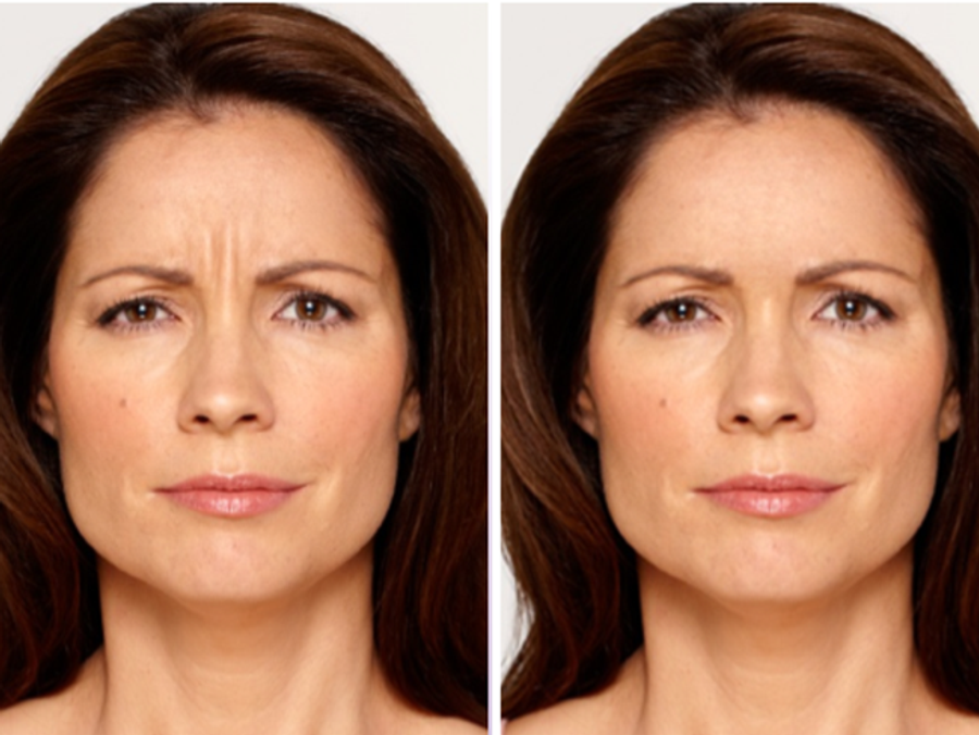 botox Main Newbeauty