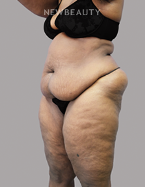 Dr. Olga Bachilo - BBL - 20102089 - Before
