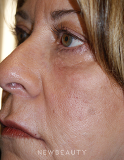 Dr. Marina Peredo Elos Injections/Liquid Lift - After